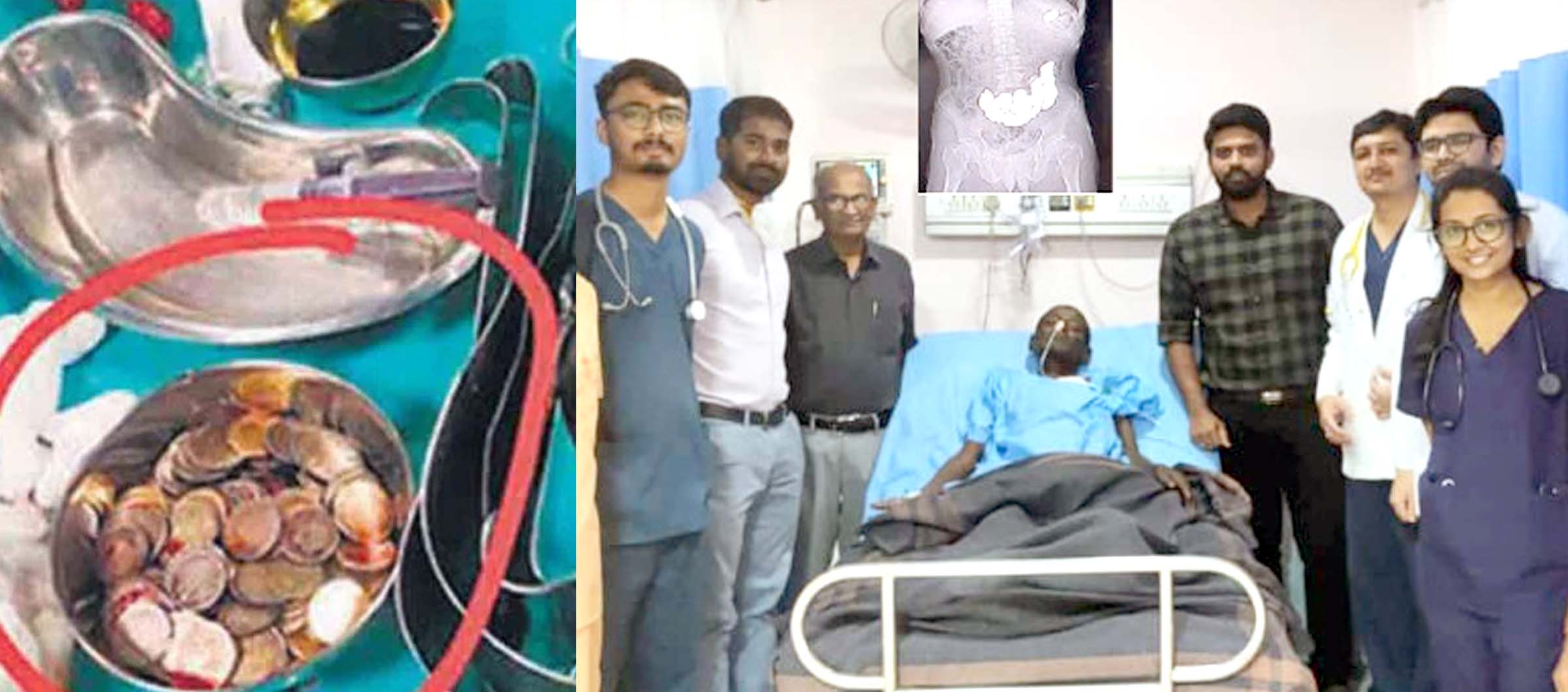 కడుపులో నాణేల గని..!