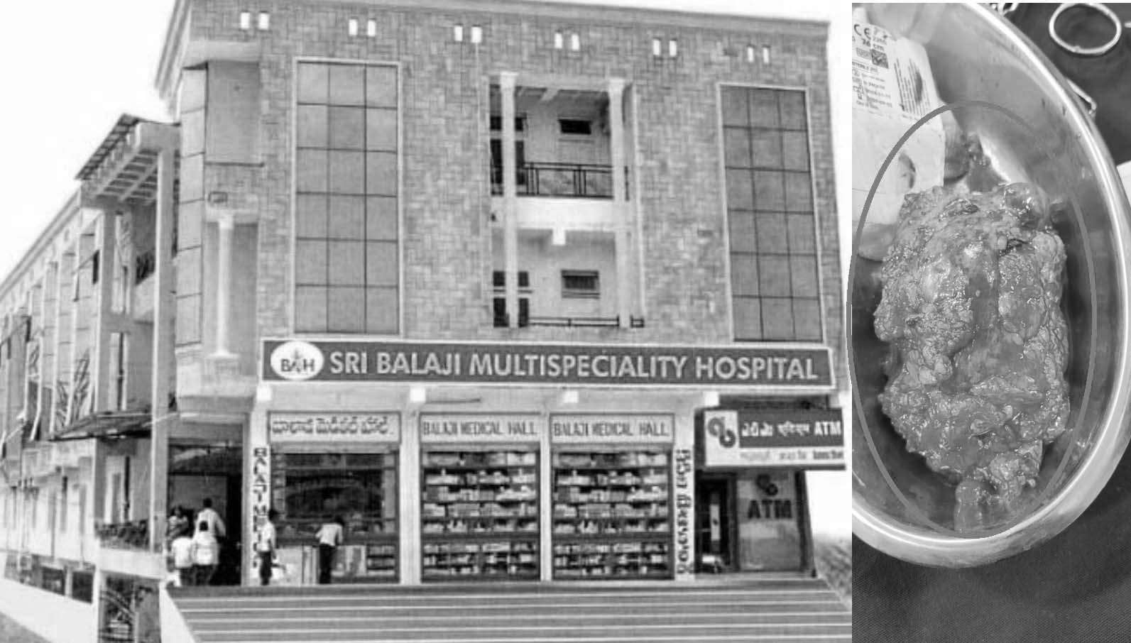 తాండూరు బాలాజీలో అరుదైన ఆపరేషన్