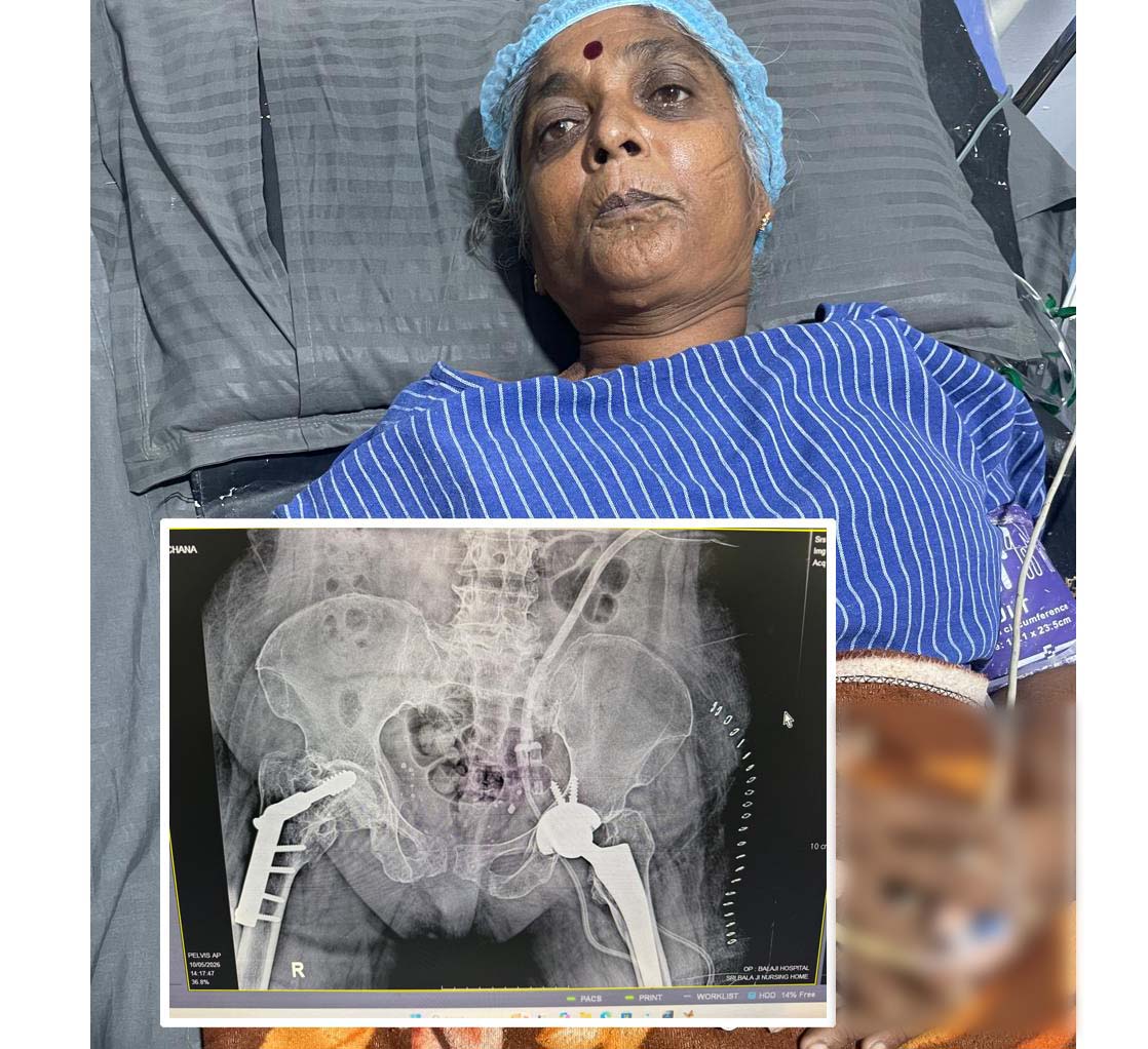మహిళకు తుంటి మార్పిడి ఆపరేషన్